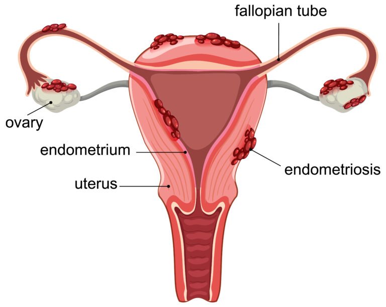 "Medical illustration showing PCOS and ovulation-related infertility in women."